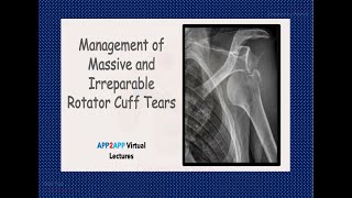 Management of Massive and Irreparable Rotator Cuff Tears [upl. by Ehlke]