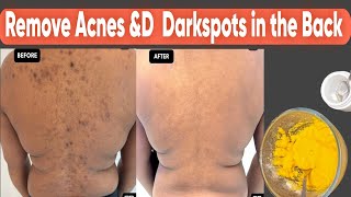 Remove dark spots ampacne in your backTry using this treatment for the dark spots on your back [upl. by Aniahs989]