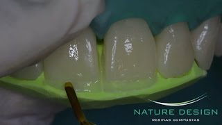 Fechamento de Diastema e Aumentos Incisais [upl. by Nilved]