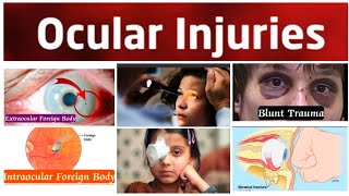 Ocular Injury 4 Major Intraocular Foreign BodiesSiderosis BulbiChalcosis and Penetrating Injury [upl. by Ibot871]