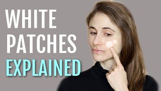 WHITE PATCHES ON THE FACE EXPLAINED PITYRIASIS ALBA DR DRAY [upl. by Pomcroy194]