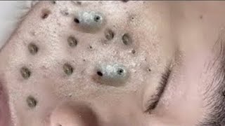 Big Cystic Acne Blackheads Extraction Blackheads amp Milia Whiteheads Removal Pimple Popping  9048 [upl. by Nnyw]