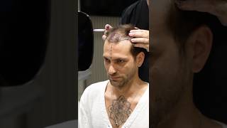 Cosmedica Clinic Hair Transplant in Turkey shorts hairtransplant video [upl. by Saidnac501]