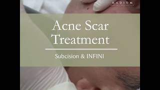 Acne Scar Removal Treatment  Subcision amp INFINI [upl. by Saihtam72]