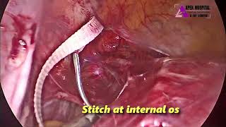 Laparoscopic Abdominal Cerclage by Dr R K Mehta  Apex Hospital Sirsa [upl. by Boigie]