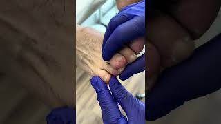 Foot Fungus Removal Before amp After Transformation FootCare HealthyFeet Transformation [upl. by Ierdna580]