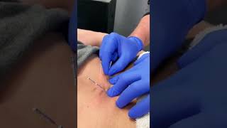 Low Back Dry Needling [upl. by Millan701]