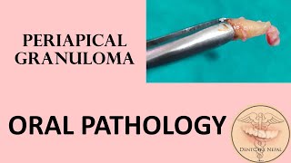 Periapical Granuloma [upl. by Marlena30]