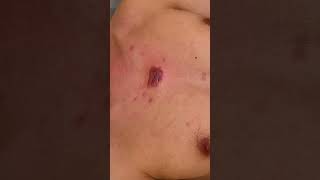 Chest keloids  Facial Keloids  treatment using intralesional chemotherapy [upl. by Cathleen]