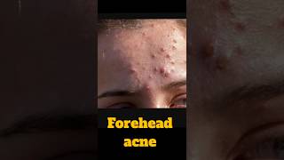 Pharmacy Cream for Acne Acne Marks Blackheads Wrinkles amp Open Pores Skincare AcneTreatment [upl. by Eiznil]