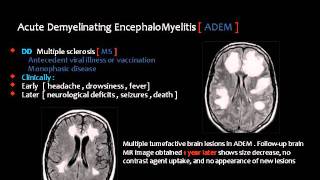 Radiology  Imaging of Intracranial Infections  Brain [upl. by Ogawa]