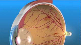 Proliferative Diabetic Retinopathy PDR [upl. by Seidler]