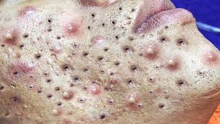 Big Cystic Acne Blackheads Extraction Blackheads amp Milia Whiteheads Removal Pimple Popping  9257 [upl. by Kathrine]