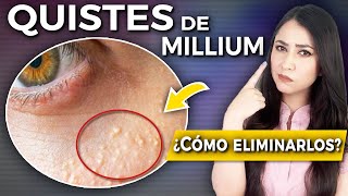 QUISTES DE MILLIUM l ¿Qué son y CÓMO ELIMINARLOS👩🏻‍⚕️ drapauzuniga [upl. by Maiah]