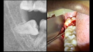Extracción MUELA DEL JUICIO horizontal  Extracción de cordal incluido [upl. by Ariajay247]