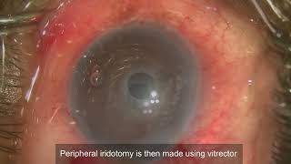 Descemet Membrane Endothelial Keratoplasty DMEK [upl. by Ycnaf]