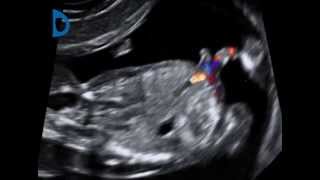 Fetal Medicine Foundation  umbilical cord duplication at 12 weeks [upl. by Sone672]