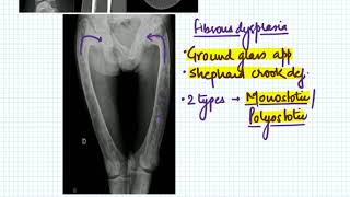 cystic lesions of bone basics [upl. by Cita]