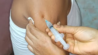 IM Intramuscular Arm injection Push Ketorolac  Ketonic  injection Ep 24 Injection Vision [upl. by Ahtis549]