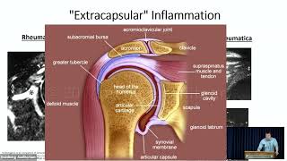 Polymyalgia Rheumatica What has changed since 1957 [upl. by Yenaiv]