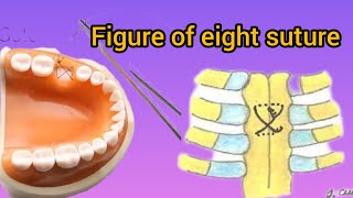 figure of 8 suture  figure of eight suture suturing technique [upl. by Nalyk]