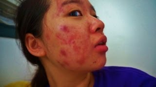 My Acne Story  18th Week of Accutane [upl. by Aneram260]