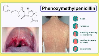 phenoxymethylpenicillin [upl. by Cyb996]