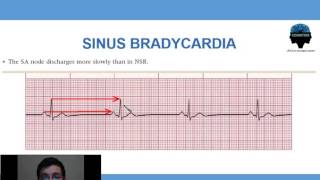 2 Bradicardia Sinusal [upl. by Einnus]