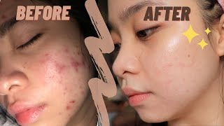 The best ANTI ACNE CREAM ✨  my holy grail  TRETINOIN [upl. by Seftton671]