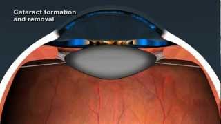 Cataract Removal and Intraocular Lenses [upl. by Marillin]