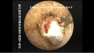 A case of cholesteatoma misdiagnosed as cerumen embolism [upl. by Elleimac]