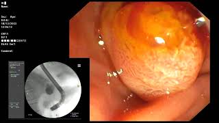 ERCP  Distal CBD stricture cytologyintraductal Bx and stenting [upl. by Aleahs]