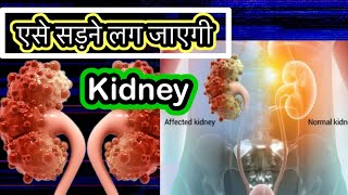 Renal Cyst Causes Signs and Symptoms Diagnosis and Treatment kidneycyst renalcyst [upl. by Nnybor434]