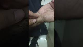 ganglion cyst at wrist [upl. by Georgiana]