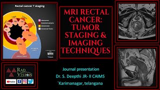 MRI RECTAL CANCERTUMOR STAGING AND IMAGING TECHNIQUES [upl. by Francklyn]