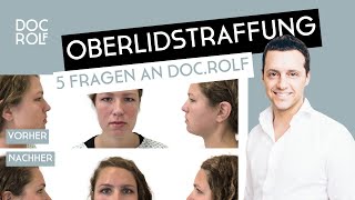 OBERLIDSTRAFFUNG OP bei Schlupflidern [upl. by Nyl798]