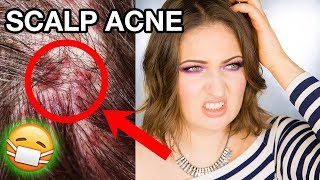 SCALP ACNE amp ITCHY DANDRUFF  How To Get Rid of It Completely [upl. by Louisa]