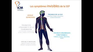 Les symptômes de la sclérose en plaques [upl. by Kcirdla207]