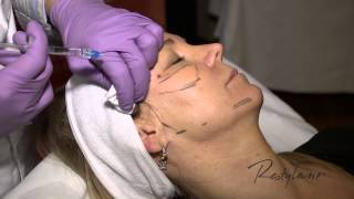 Dr Berne Harmony Program Oslo Restylane Tear Trough and Cheeks [upl. by Sheri302]