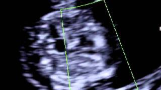 Fetal heart scan at 11 weeks of pregnancy [upl. by Anahsal962]