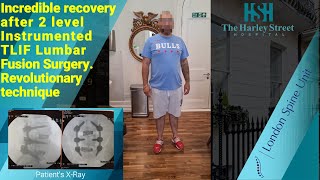 Incredible recovery after 2 level Instrumented TLIF Lumbar Fusion Surgery Revolutionary technique [upl. by Haniraz]