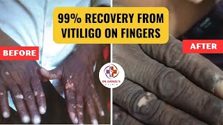 99 recovery from Vitiligo on fingers  Dr Danial Clinic Live  vitiligotreatment ankleshwar [upl. by Sancho]