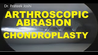 Arthroscopic Abrasion Chondroplasty  Chondromalacia Patella  Dr Prateek Joshi arthroscopy ortho [upl. by Sito79]