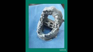 zirconia Crown fabricated with help of Dental Scan without impression procedure [upl. by Maighdlin]