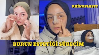 BURUN AMELİYATI SÜRECİM  VLOG [upl. by Ana566]