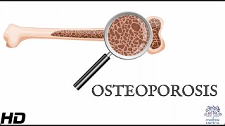 Osteoporosis Everything You Need To Know [upl. by Akeenat]