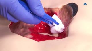 How to Effectively Cleanse and Debride a Wound  Wound Cleansing and Debridement  Ausmed Education [upl. by Handbook]