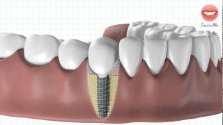 Vidéo de démonstration pour une pose dimplant dentaire [upl. by Sidon344]