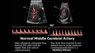 Fetal Middle Cerebral Artery Doppler Ultrasound Normal Vs Abnormal Image Appearances  MCA USG [upl. by Ekle745]