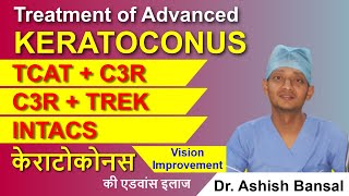 Advanced Keratoconus Treatment C3R Plus TCAT with C3R TREK INTACS  Keratoconus Surgery [upl. by Ailasor]